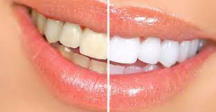 3 diy teeth whitening methods