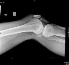 a hypoplastic patella fracture in nail