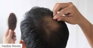 See more of cara merawat rambut gugur dan kelemumur on facebook. Lelaki Umur Belum 30 Tahun Tapi Rambut Dah Nipis Ambil Tahu 10 Perkara Ini Untuk Elak Rambut Gugur