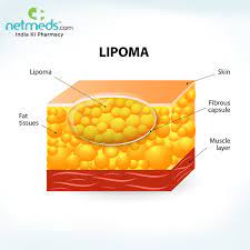 lump under your skin it could be a lipoma
