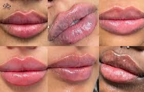 wanted lip fillers russian lip