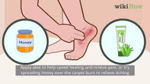 how to treat carpet burns with
