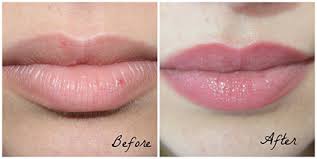 the permanent solution for your lips