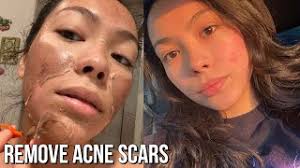 First Chemical Peel Experience! | Results Before & After - YouTube