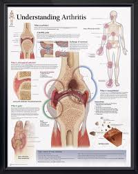Understanding Arthritis Chart 22x28 Physiotherapy