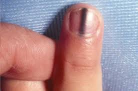 what does black stripe on nail indicates