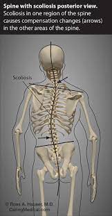 prolotherapy for scoliosis caring