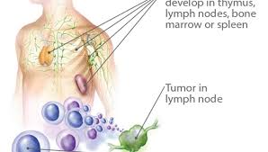 Lymphoma is a group of blood malignancies that develop from lymphocytes (a type of white blood cell). Lymphoma Cancer That Challenges Your Immune System Positive Bioscience