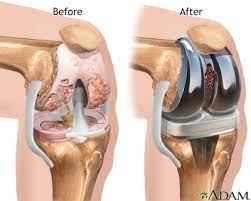 knee joint replacement medlineplus