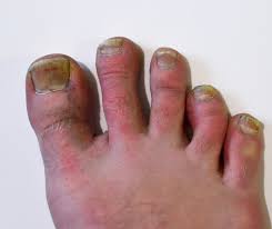 blue discolored feet what you should