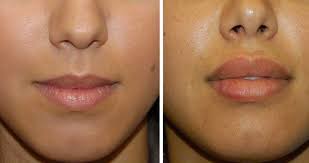lip reduction surgery cost in nairobi