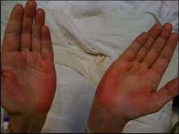 The remainder of the physical exam was within normal limits./p> case #2 Liver Palms Palmar Erythema The American Journal Of Medicine
