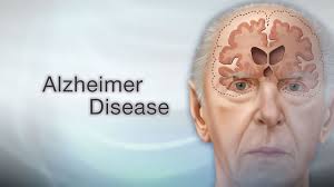 alzheimer disease information mount