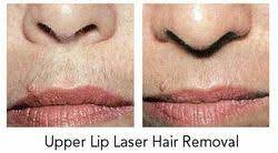 laser hair removal treatment for upper