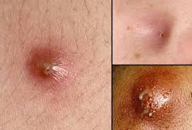 Ingrown hair cyst in your groin area may be concealed from the watching eyes of the public, but its effects are by no means completely coverable. Boils Pictures On Skin Causes And Treatment