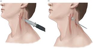 penetrating neck injuries rebel em