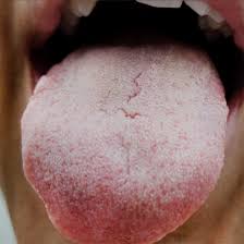 what white tongue means what to do