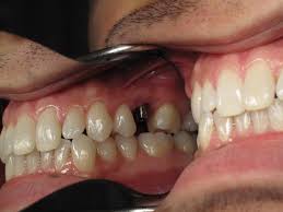 wisdom teeth extraction coronectomy