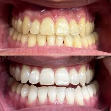 teeth whitening rittenhouse smiles