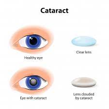 vision after cataract surgery