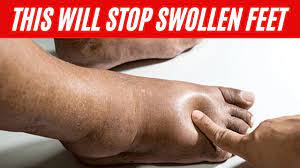 16 home remes for swollen feet