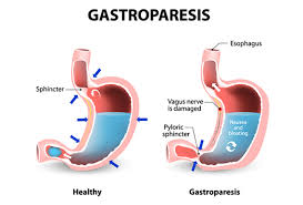 gastroparesis treatment symptoms