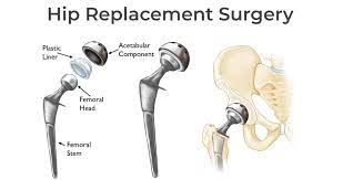 hip replacement surgery capsuerprises