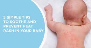 heat rash baby tips s for