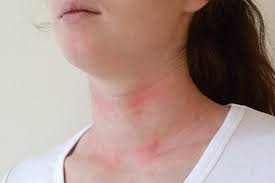 what are hives skin rash south ta