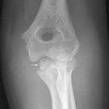 Note the median nerve crosses the anterior capsule of the elbow joint, running into. Easy Notes On Medial Epicondyle Of Humerus Learn In Just 3 Mins Earth S Lab