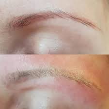 Not a week goes by where eye art studio don't receive an email, a text, a call from an anxious caller who has had their eyebrow tattoo done somewhere else, and are asking for our advice and assistance in how. Tattoo Eyebrow Removal Before And After Lorena Oberg