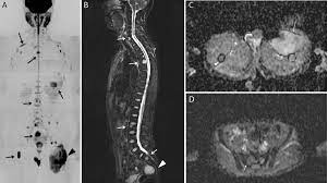 myxoid liposarcoma mls