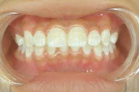 white spots on teeth causes
