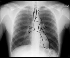 Many clinical conditions can be evaluated by this simple radiology test. The Chest X Ray In Cardiovascular Disease Wikidoc