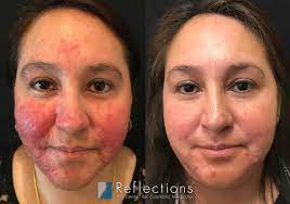 rosacea treated with laser for amazing