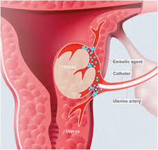 uterine fibroid embolization ufe