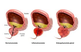prostate artery embolization st