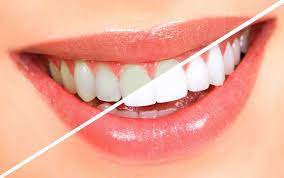 Professional Teeth Whitening Near Me | Teeth Bleaching in Wichita, KS |  Prairie Rock Dental