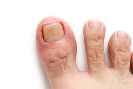 causes of curled toenails feet first