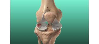 knee meniscus damage does it heal on