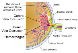 retinal vein occlusion central and