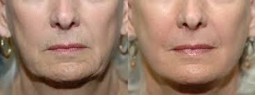 going for a laser resurfacing treatment