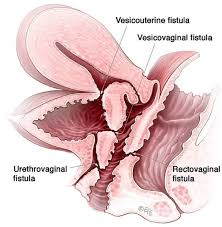 obstetric pelvic floor disorders