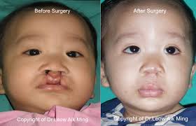 cleft lip and cleft palate surgery