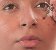 tips to remove freckles naturally
