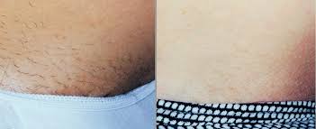 underarms and hands laser hair removal