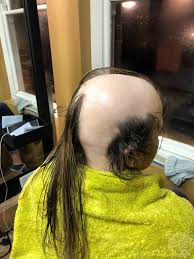 Further, genetic thinning conditions such as male and female pattern hair loss can also start at this age. Not Quite A Teenage Dream Alopecia Hit This Irish Girl At The Age Of Sixteen Media Drum World