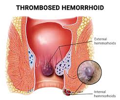 top signs of a thrombosed hemorrhoid