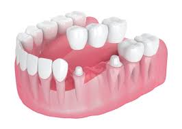 Clearchoice dental implants: BusinessHAB.com
