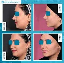How much is chin lipo uk. Double Chin Surgery In Iran Double Chin Removal Ariamedtour